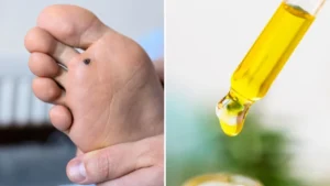 verruga plantar oleo essencial