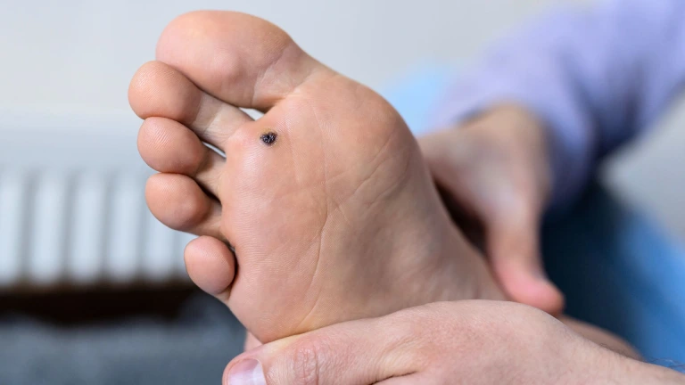 verruga plantar pe direito